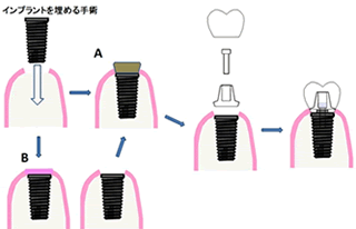 インプラント治療の手順